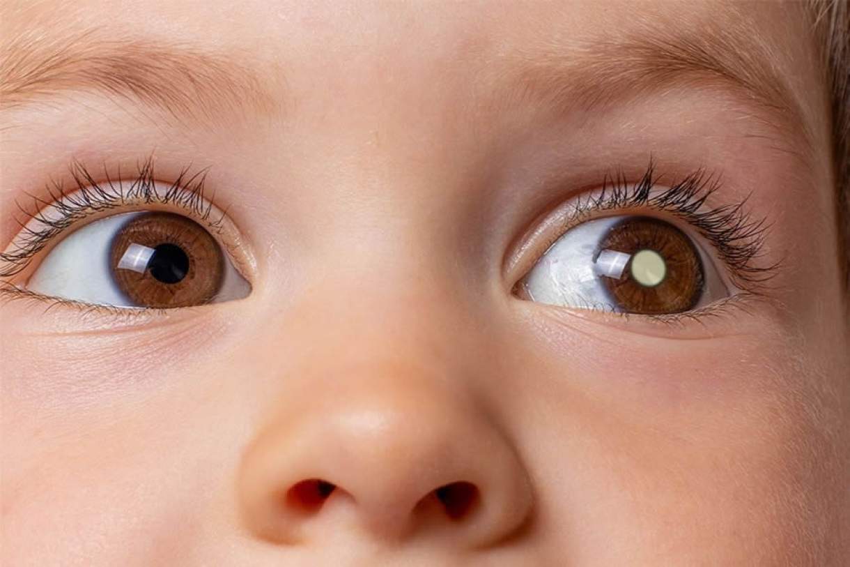 Retinoblastoma: sinais de alerta e a importancia do teste do olhinho